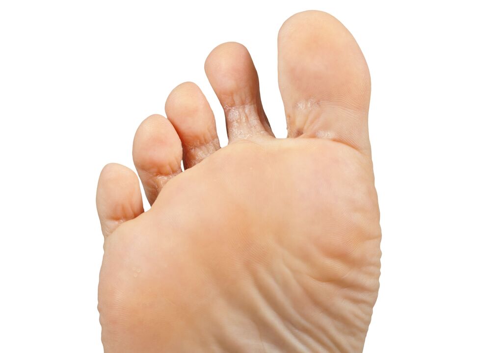 Fungers-en-pair-en-hectisch-cream-demyxil