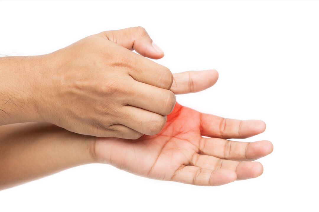 Jeuk met schimmel en de behandeling ervan met Demyxil Cream