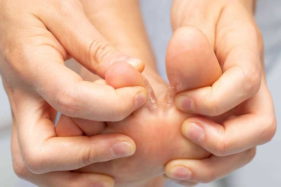 Schimmel tussen de tenen en de behandeling ervan met Demyxil CREAM