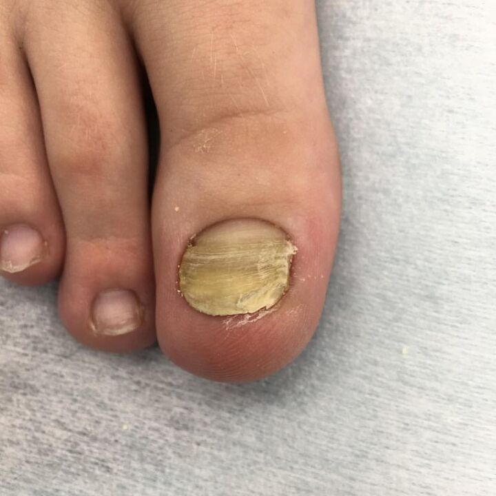 infectie met een schimmel