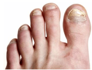 Nagelschimmel