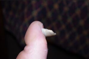 Symptomen van schimmel op de nagels