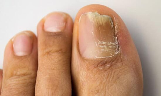Distaal-lateraal type schade met onychomycosis op de benen