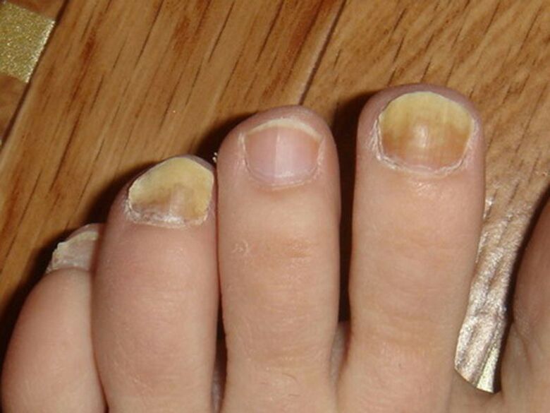 schimmelinfectie van teennagels