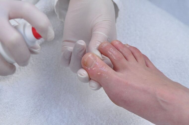 behandeling van de nagelplaat voor schimmelinfectie